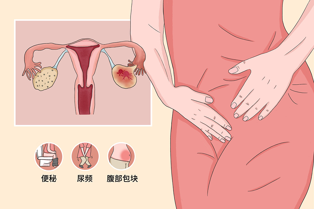 卵巢癌的症状
