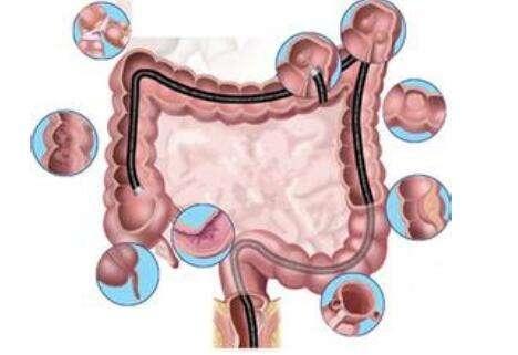 结直肠癌的诊断方法有哪些