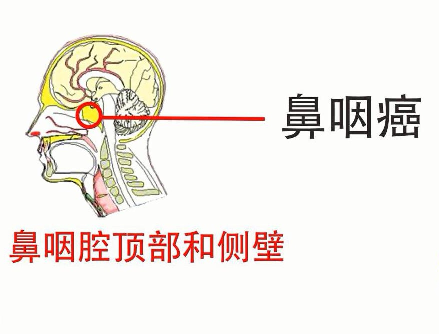 什么是鼻咽癌