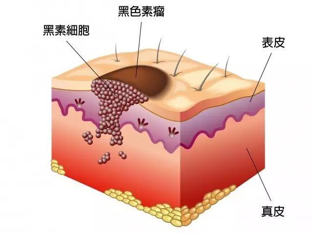 黑色素瘤诊断方法有哪些