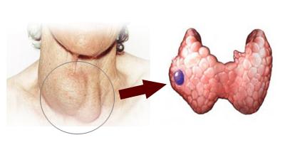 甲状腺癌是什么原因引起的_甲状腺癌的病因_甲状腺癌是怎么回事