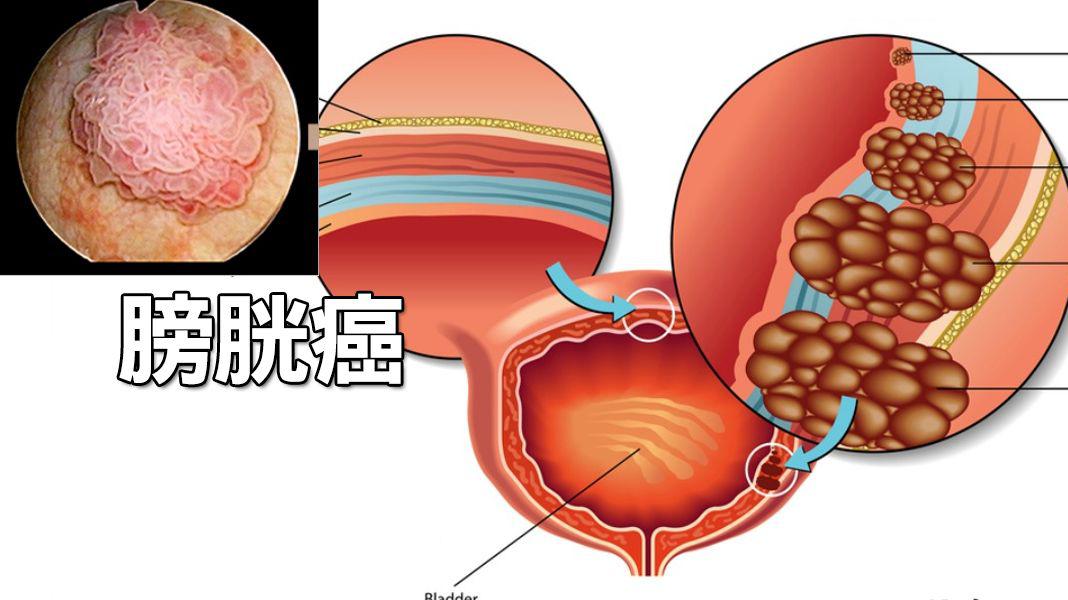 什么是膀胱癌