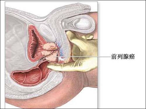 前列腺癌护理措施