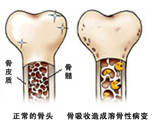 骨癌简介