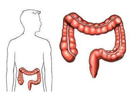 结肠癌疾病的高发人群